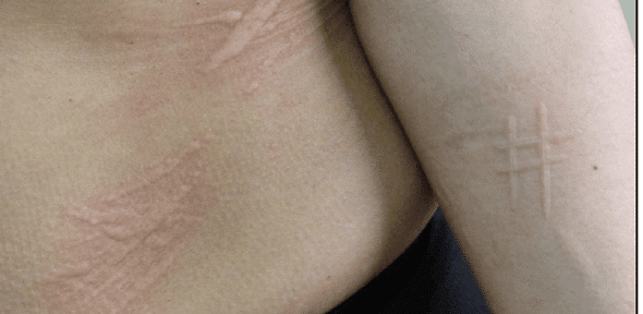 Dermografizm (Dermatografizm, Dermatografi, Dermatografik Ürtiker, Urticaria Faktisiya)