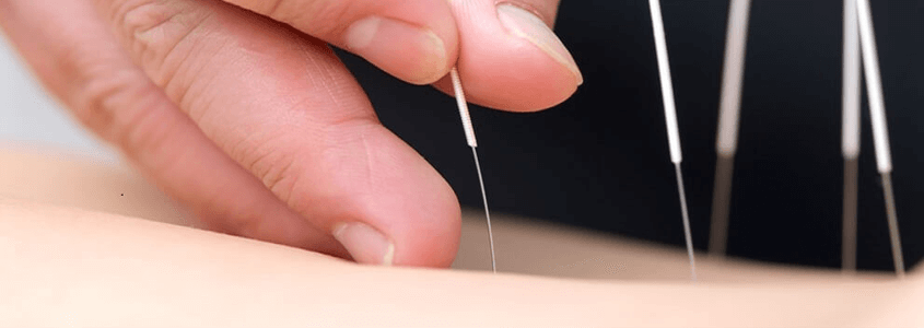 Ürtiker Tedavisinde Akupunktur
